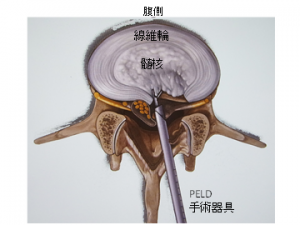経椎弓間法